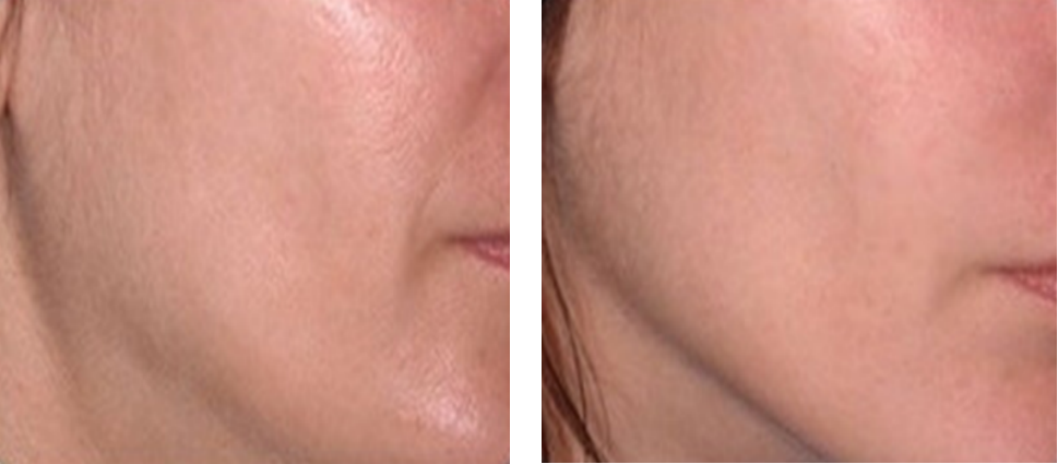 Hifu Face Lifting Machine Professional For Face Lifting Wrinkle Removal