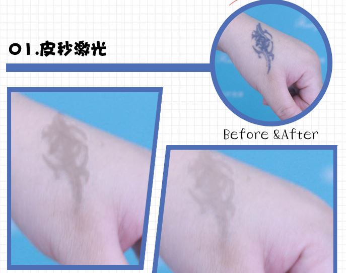Pico Second Laser Pigment Removal Pico Second Laser Pigment Removal