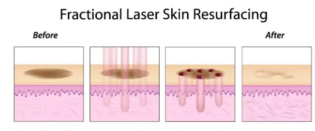 Fractional CO2 10600nm Laser Machine Fractional CO2 10600nm Laser Machine