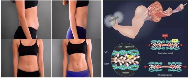 Emsculpt Build Muscle machine