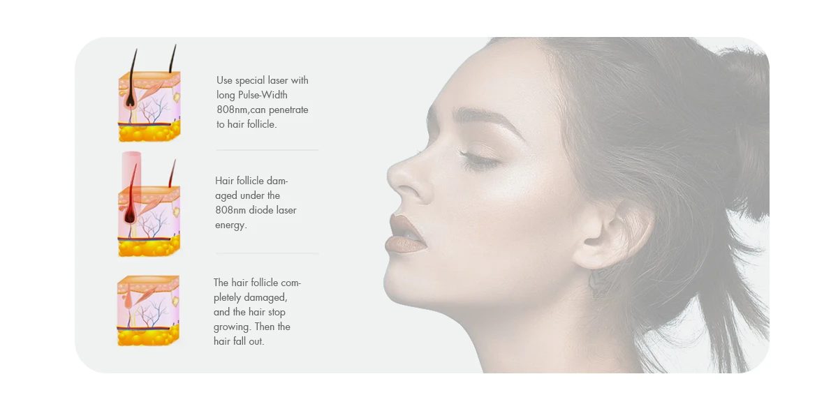 sanhe Diode Laser Hair Removal 